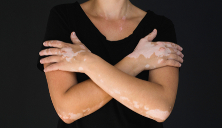 ויטליגו - תמונת המחשה